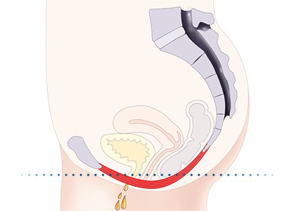 Pelvic-Floor Muscle Repair 5 Pelvic floor muscles Sheffield