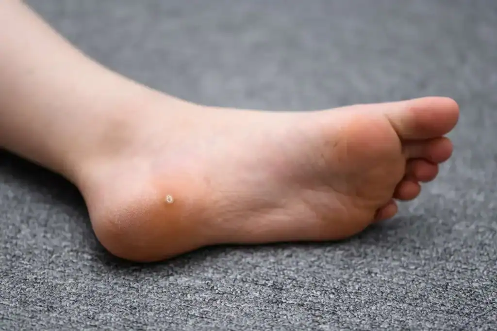 Cryotherapy For Warts And Also Verrucas 2 Image of verruca on the bottom of the foot that able to be treated with Cryotherapy Sheffield