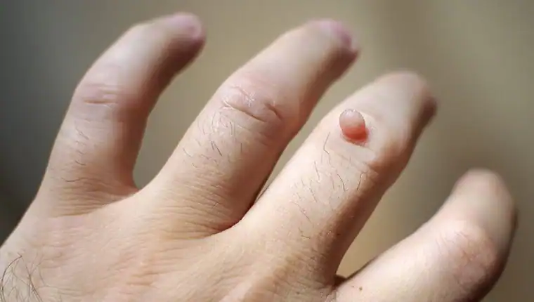 Cryotherapy For Warts And Also Verrucas 1 Image of blemish that Cryotherapy Sheffield can remove with Lipo 360.